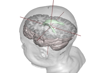 Image showing part of the brain enlarged with autism