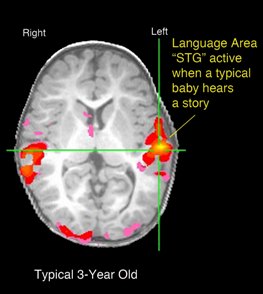 fMRI image of brain lit up when baby hears a sound