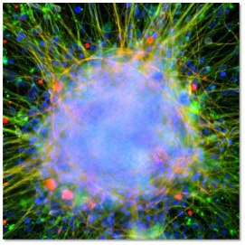 Neurons differentiated from hiPSCs from a patient with ASD