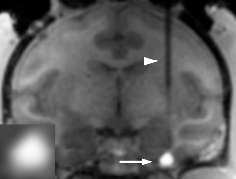 mri of brain showing where the bdnf gene will be delivered