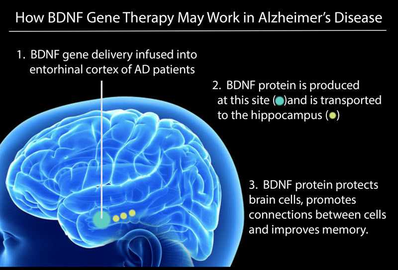how bdnf gene therapy may work in alzheimer's disease. 1) Bdnf gene delivery infused into entorhinal cortex of AD patients 2) bdnf protein is produced at this site and is transported to the hippocampus 3) bdnf protein protects brain cells, promotes, connections between cells, and improves memory