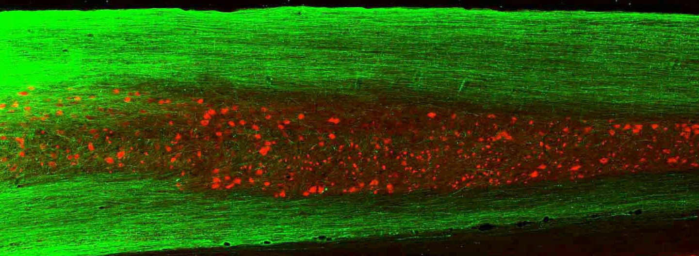 Human ES cells implanted into Rat with complete spinal cord transection. Human axons (green) stream from the lesion site (LEFT) into the caudal spinal cord