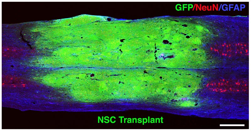 nsc transplant mri 