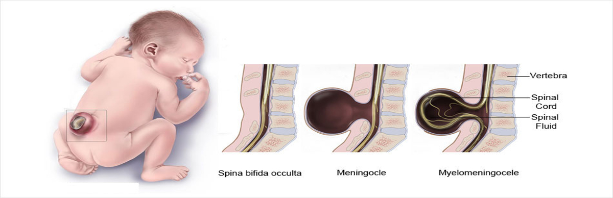 baby with open neural tube defect 