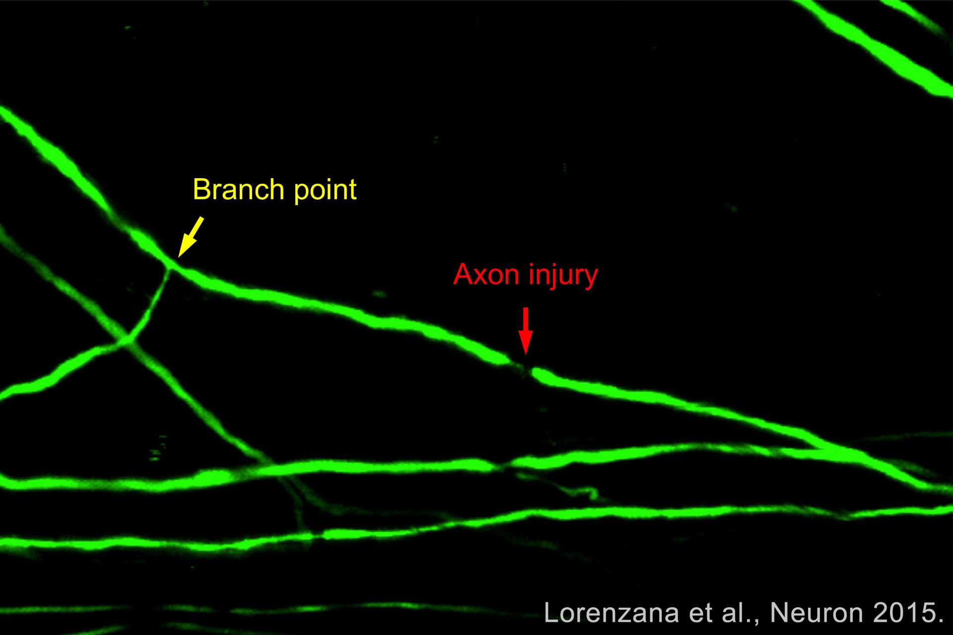 mri image of brain axon injury 